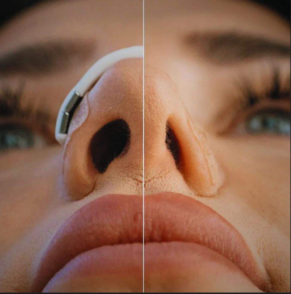 Magnetne trakice za nos